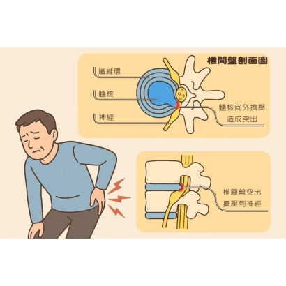 什麼是椎間盤突出.jpg