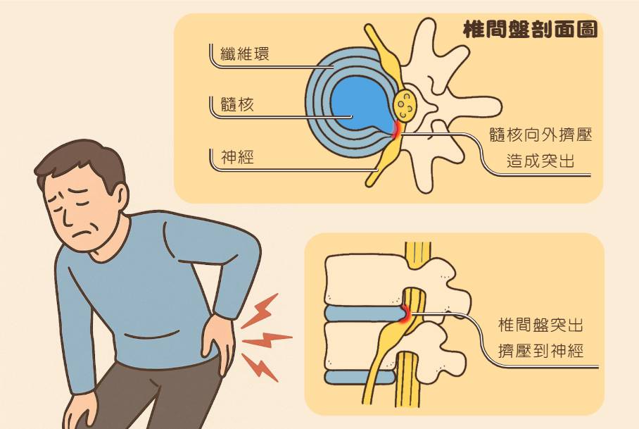 臺灣脊骨矯治醫學會 椎間盤突出