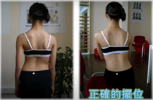 施羅斯側彎矯正運動 擺位