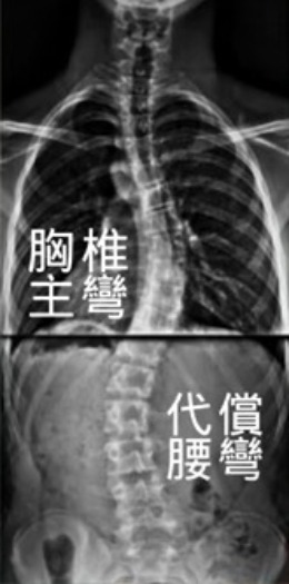 脊椎側彎 代償彎