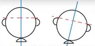 臺灣脊骨矯治醫學會 脊椎側彎 頭部歪斜