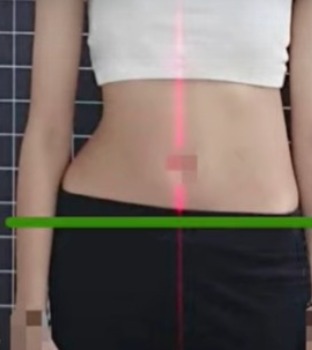 臺灣脊骨矯治醫學會 脊椎側彎 骨盆歪斜