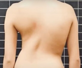 臺灣脊骨矯治醫學會 脊椎側彎 肩胛骨高低