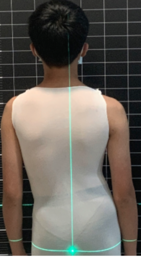 臺灣脊骨矯治醫學會 脊椎側彎 體態歪斜