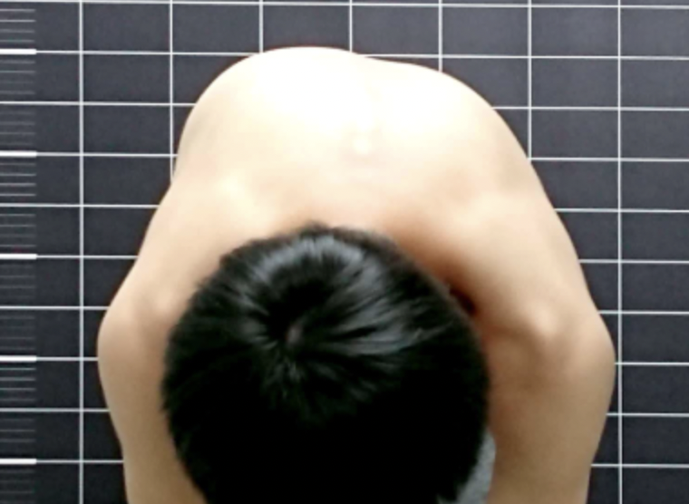 臺灣脊骨矯治醫學會 亞當前彎